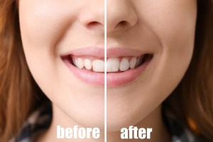 Gingivectomy before and after