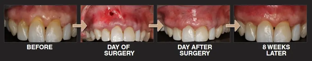 pinhole surgical technique before and after