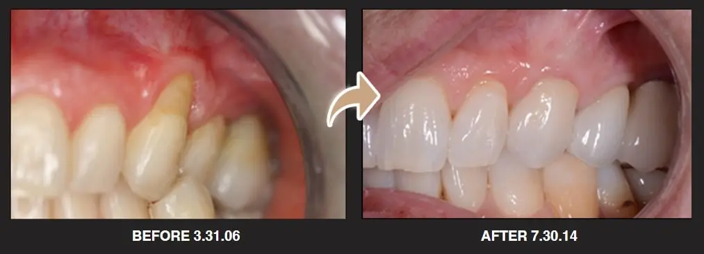 pinhole surgical technique before and after